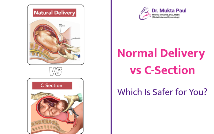 Normal Delivery vs C-Section: Which Is Safer for You?