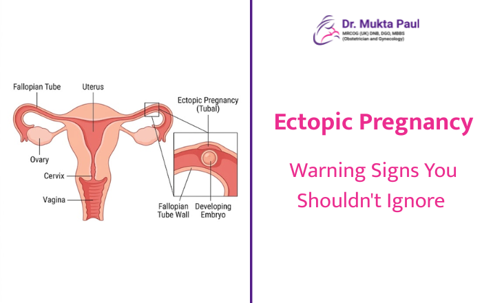 Ectopic Pregnancy: Warning Signs You Shouldn't Ignore